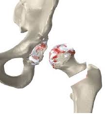 hip replacement doctor baltimore.jpeg