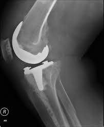 knee replacement doctor baltimore.jpg